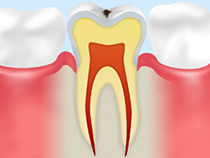 CO ごく初期の虫歯
