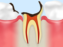 C4 歯根に達した虫歯