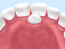 過剰歯の抜歯