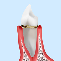 歯肉炎・軽度歯周炎