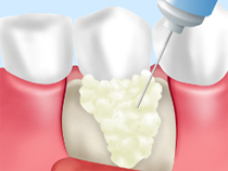 エムドゲイン（歯周組織再生療法）